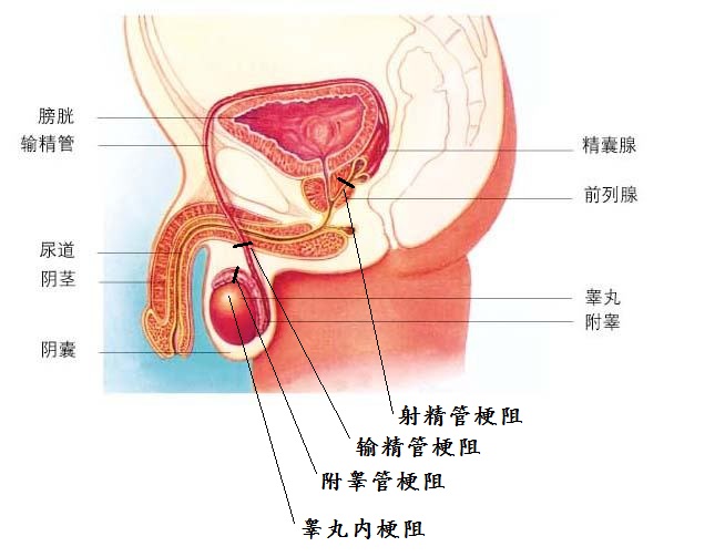 无精症梗阻部位.jpg