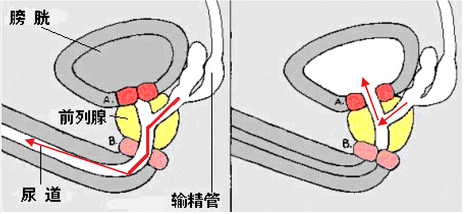 逆行射精.jpg